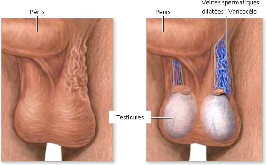 Varicocele