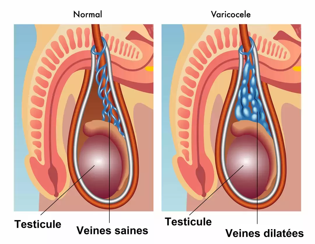 Varicocele