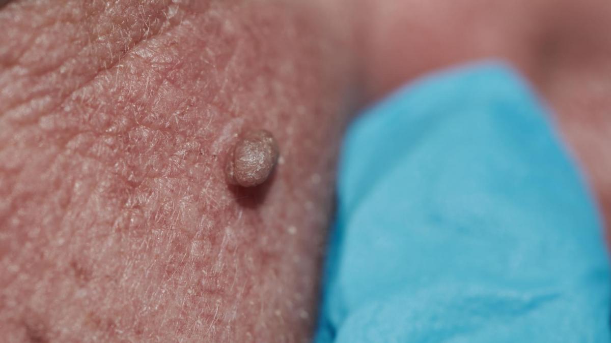 Condylomes : Remèdes Naturels, Conseils, Causes et Symptômes